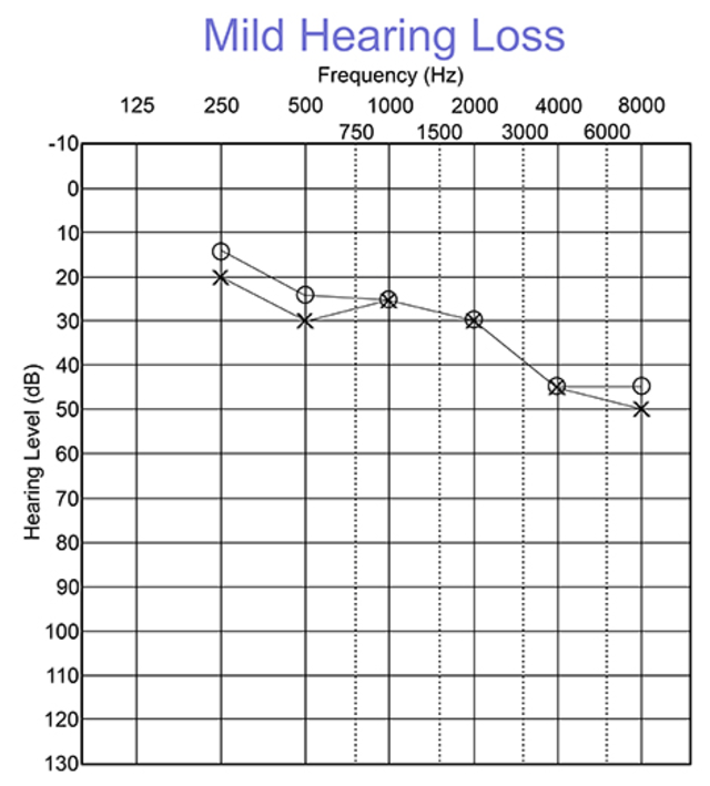 Audiogram with mild hearing loss