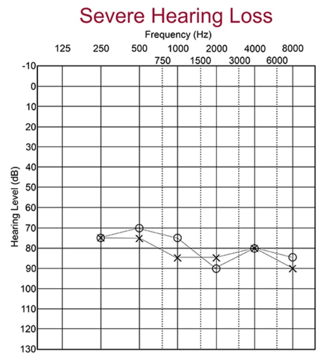 Audiogram with severe hearing loss