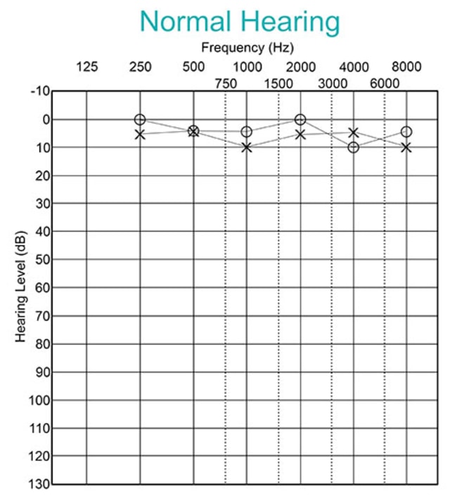 Audiogram with normal hearing levels