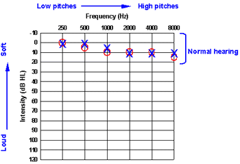 audiogram