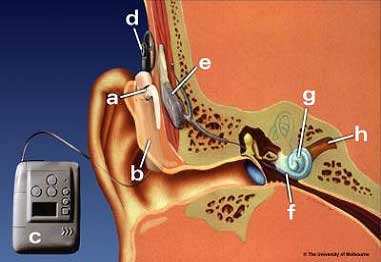 cochlear implant