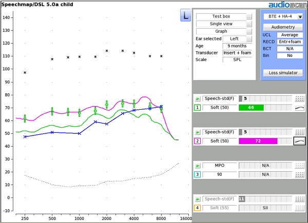 Figure 3. Comparison of well-fit and poorly-fit hearing aid.